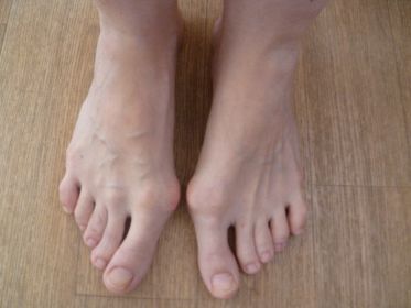 Ювенильный hallus valgus